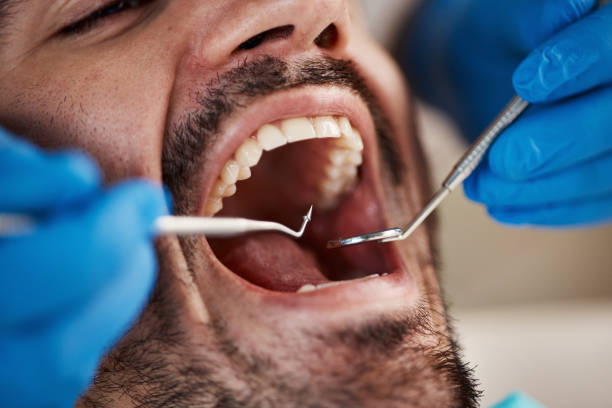 Best Knocked-Out Tooth (Avulsed Tooth) Treatment in Salina, KS