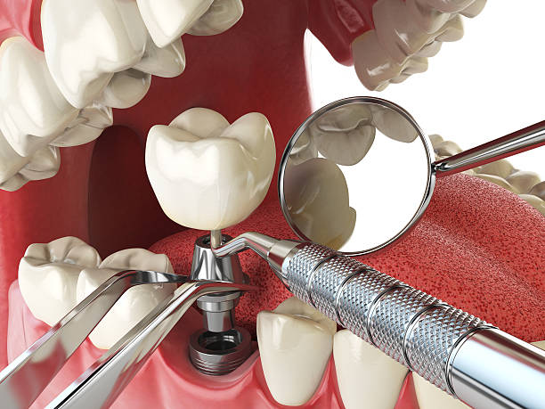 Best Lost Filling or Crown Replacement in Salina, KS